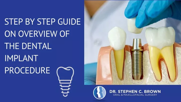 PPT - Step by step guide on overview of the dental implant procedure ...