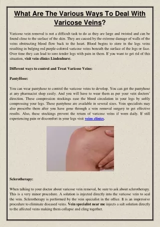 what are the various ways to deal with varicose