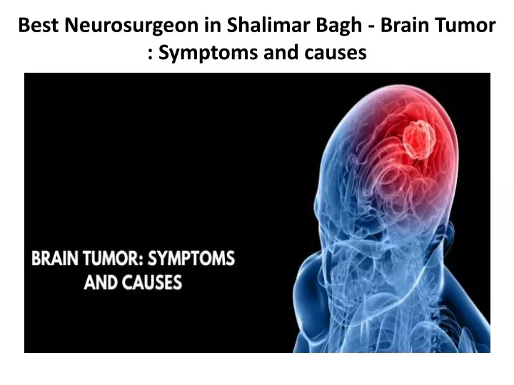 best neurosurgeon in shalimar bagh brain tumor