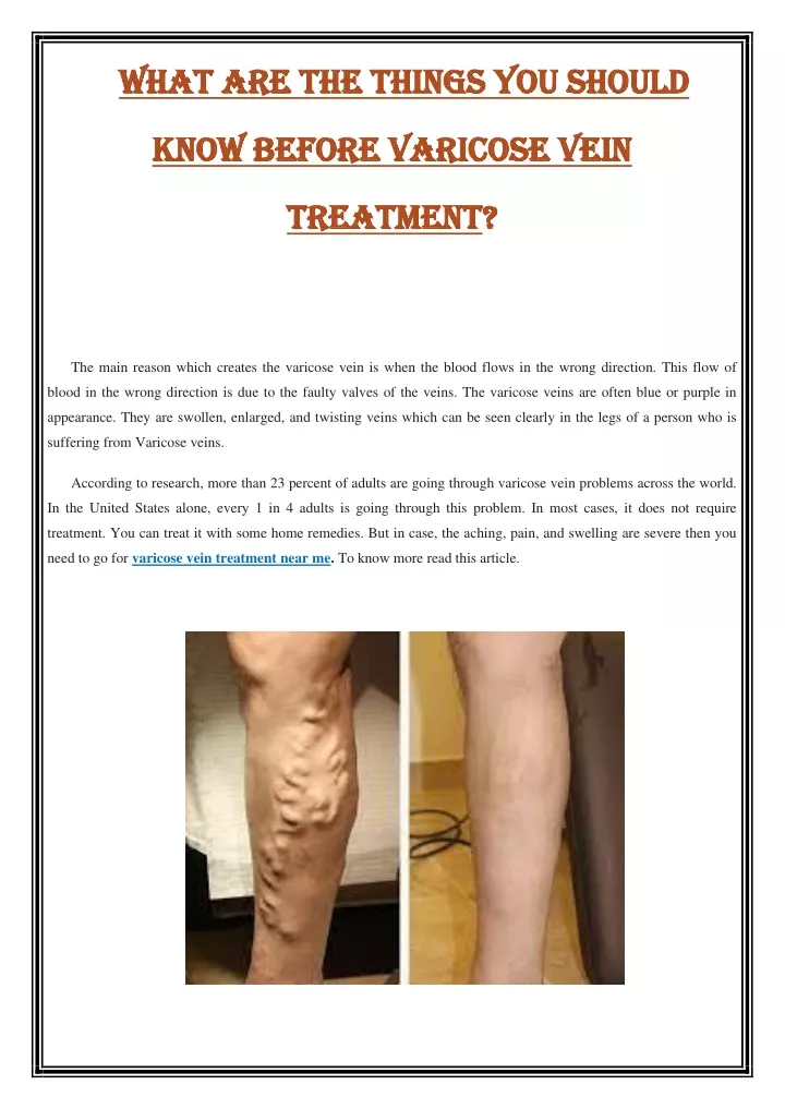 Ppt What Are The Things You Should Know Before Varicose Vein