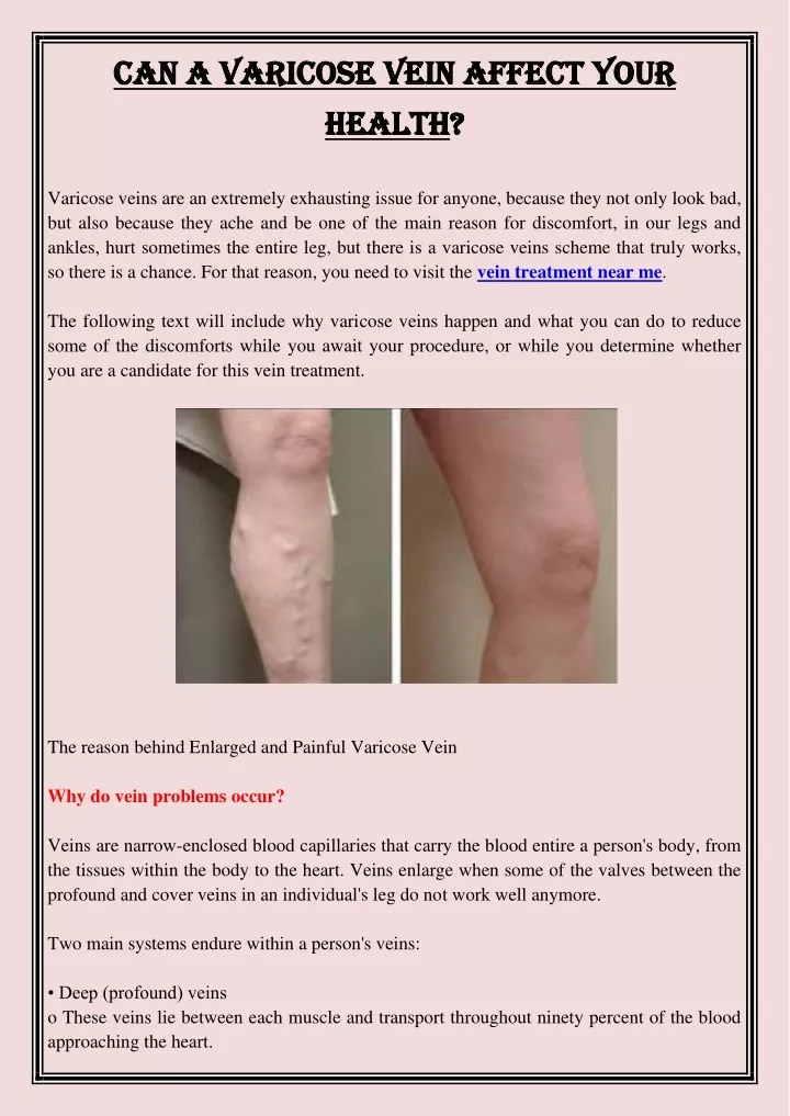 can a varicose vein affect your can a varicose