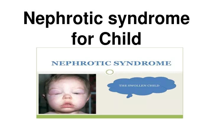 nephrotic syndrome for child