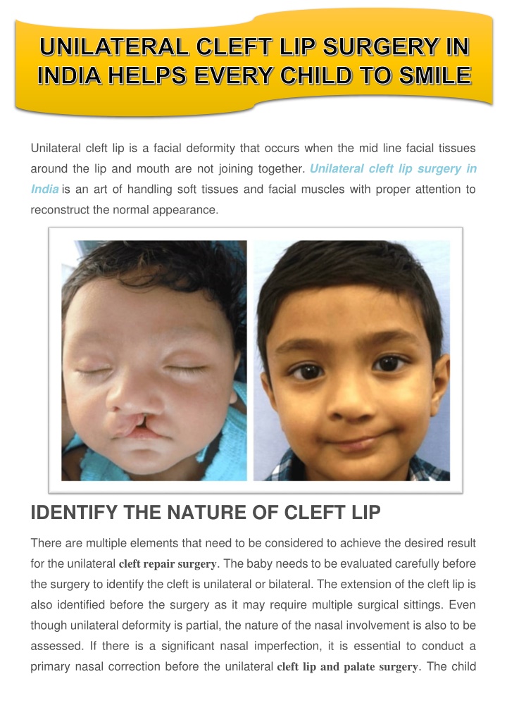 unilateral cleft lip is a facial deformity that