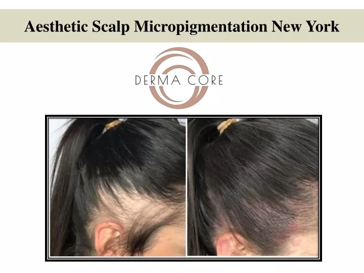 aesthetic scalp micropigmentation new york