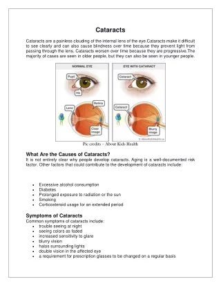 cataracts