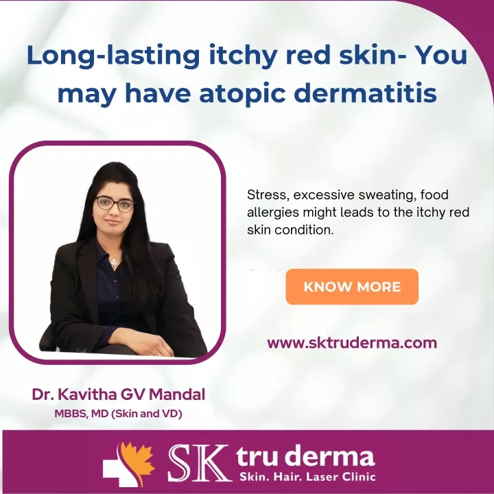 long lasting itchy red skin you may have atopic