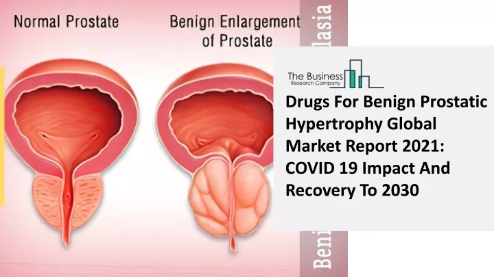 drugs for benign prostatic hypertrophy global