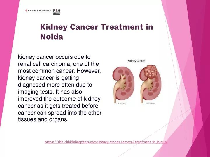 kidney cancer treatment in noida