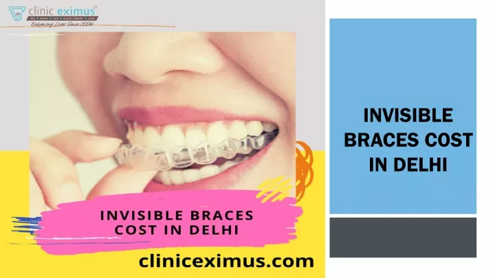 invisible braces cost in delhi