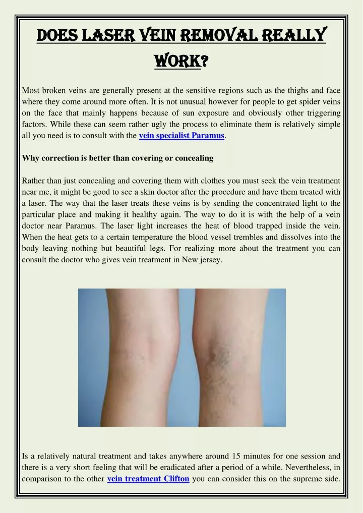 does laser vein removal really does laser vein