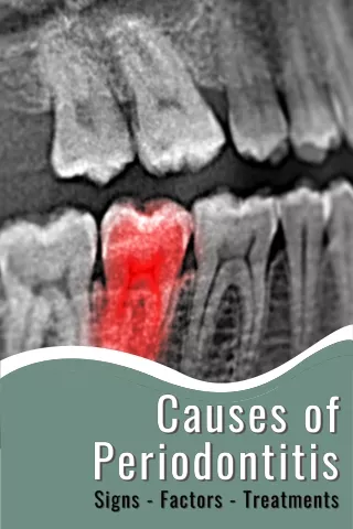 Causes of Periodontitis