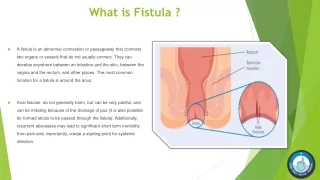 what is fistula