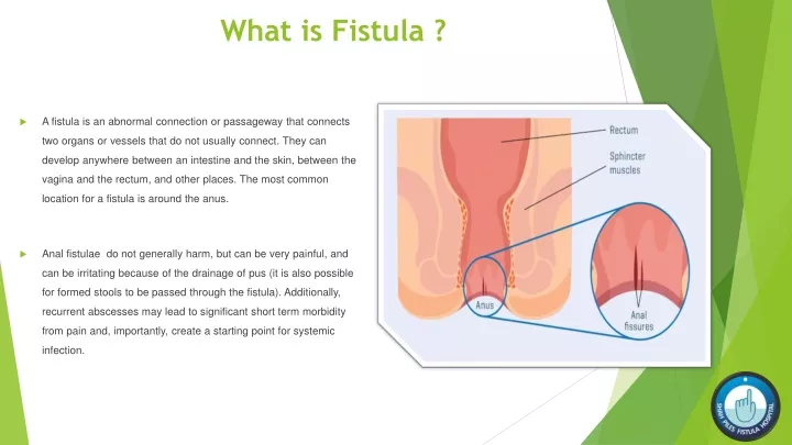 what is fistula