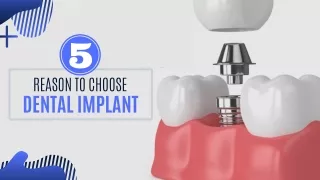 5 Reason to Choose Dental Implant