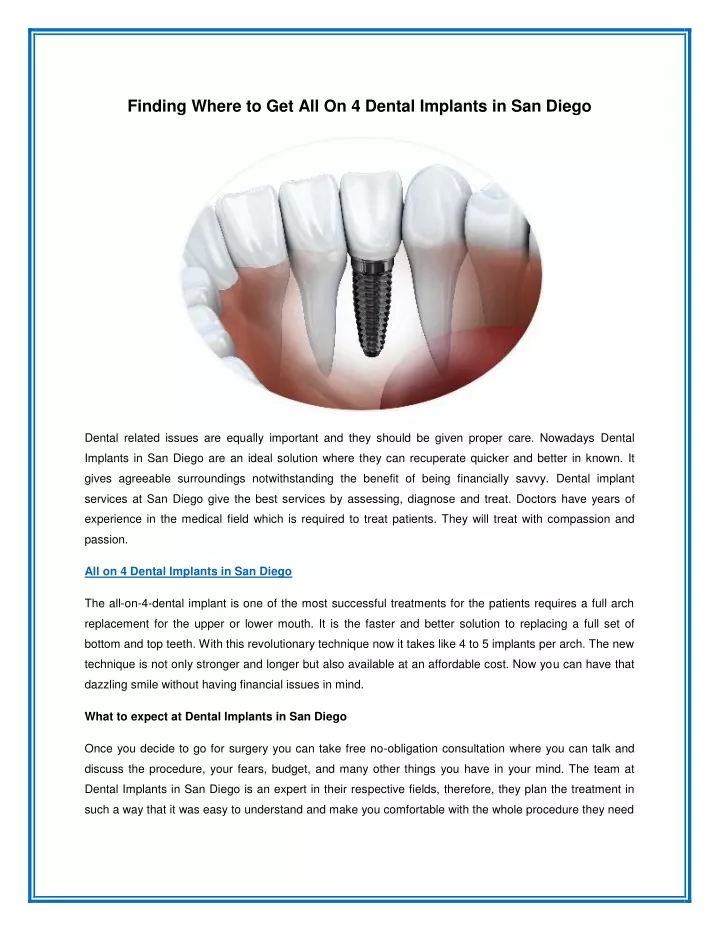 finding where to get all on 4 dental implants