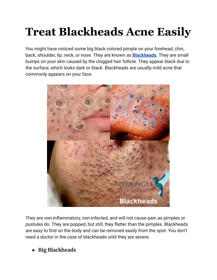 treat blackheads acne easily