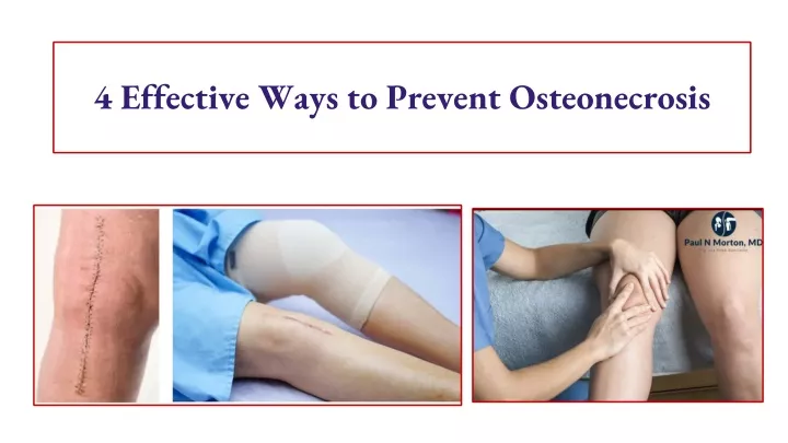 4 effective ways to prevent osteonecrosis