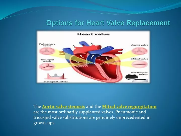 options for heart valve replacement
