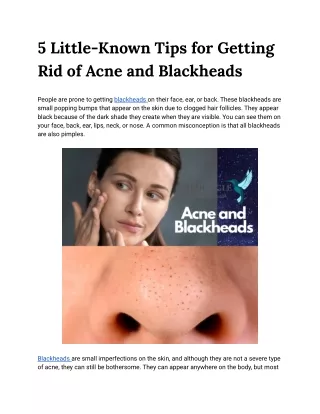 5 Little-Known Tips for Getting Rid of Acne and Blackheads
