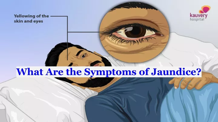what are the symptoms of jaundice