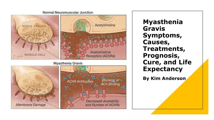 myasthenia gravis symptoms causes treatments prognosis cure and life expectancy