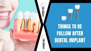 Replace Missing Tooth With Implants