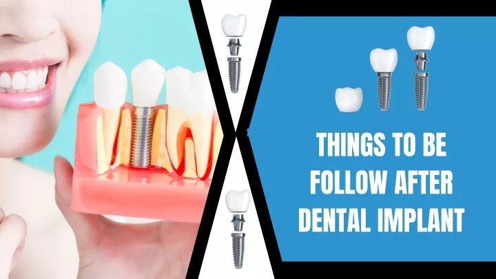 things to be follow after dental implant