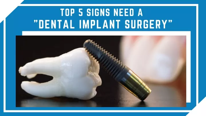 top 5 signs need a dental implant surgery