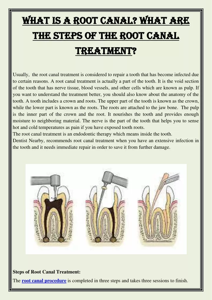what is a root canal what are what is a root