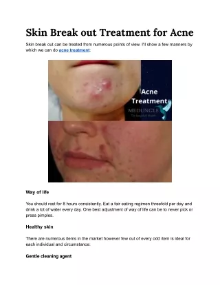 Skin Break out Treatment for Acne