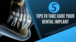 5 Tips to Take Care Your Dental Implant