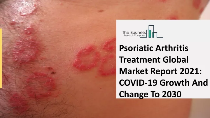 psoriatic arthritis treatment global market