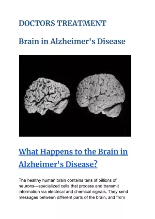Brain in Alzheimer's Disease FREE TREATMENT