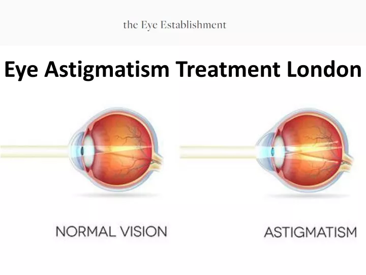 eye astigmatism treatment london