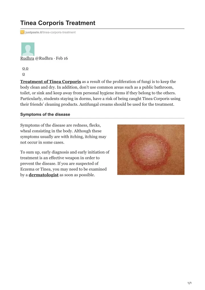 tinea corporis treatment