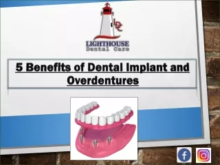 5 Benefits of Dental Implant and Overdentures