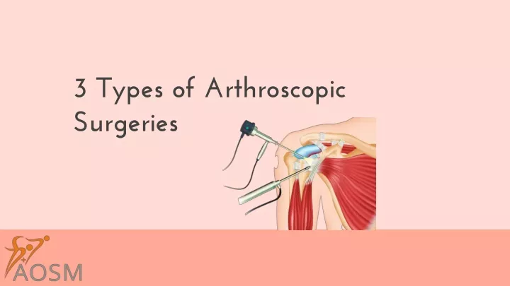 3 types of arthroscopic surgeries