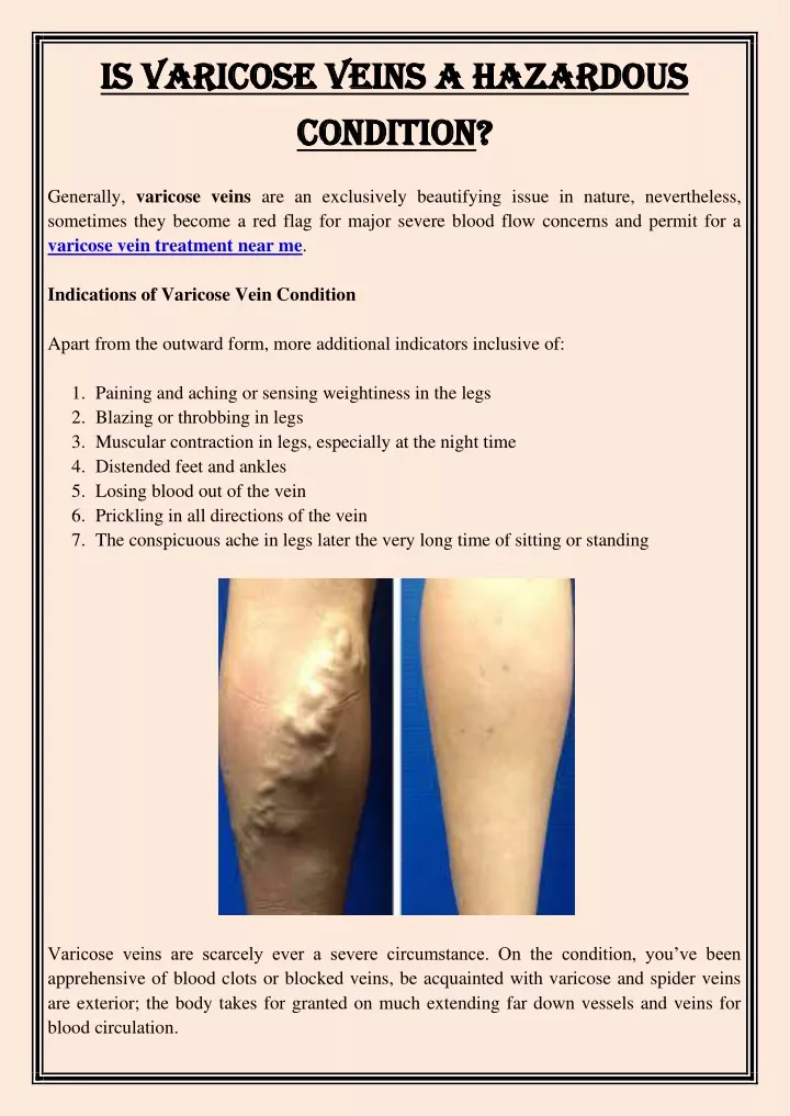 is varicose veins a hazardous is varicose veins