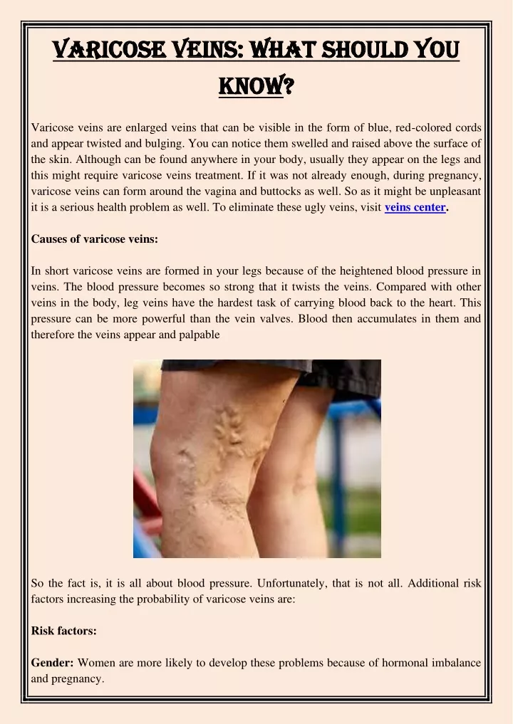 varicose veins what should you varicose veins