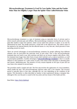Microsclerotherapy Can Be Used To Cure Telangiectasia Condition