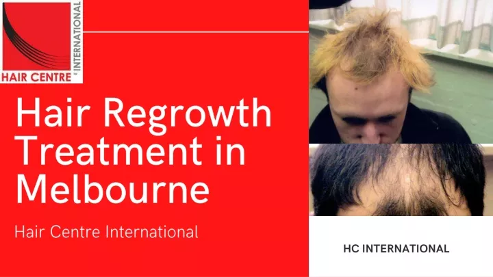 hair regrowth treatment in melbourne