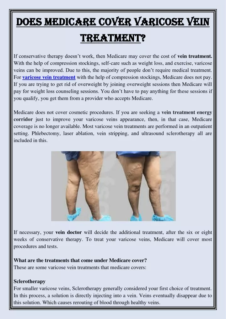 does medicare cover varicose vein does medicare