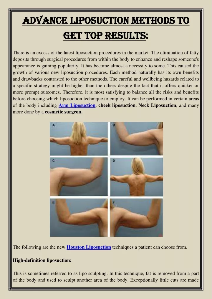 advance liposuction methods to advance