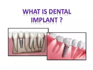 What is Dental Implant ?