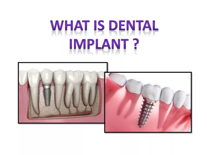 what is dental implant