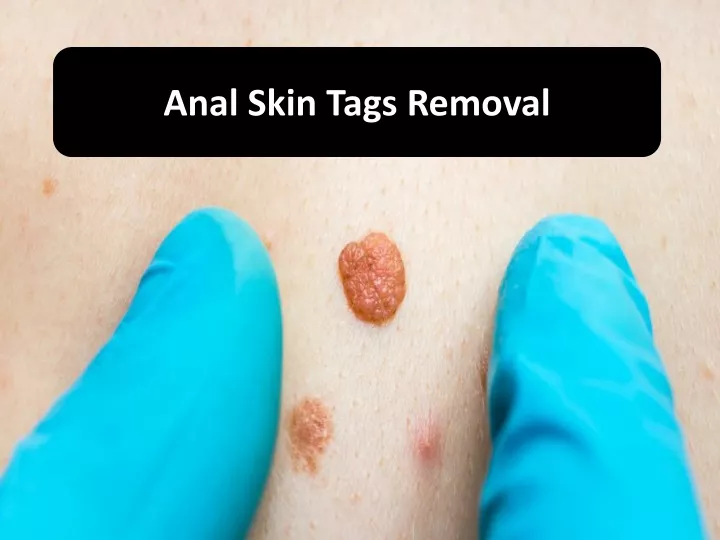 anal skin tags removal