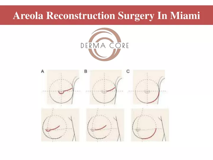 areola reconstruction surgery in miami