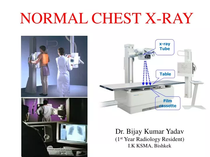 normal chest x ray