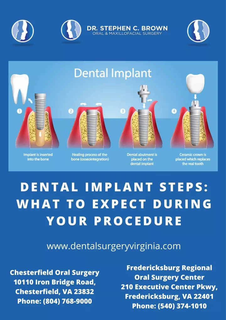 dental implant steps what to expect during your