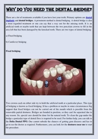 why do you need the dental bridge why do you need